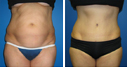 Before & After Photos